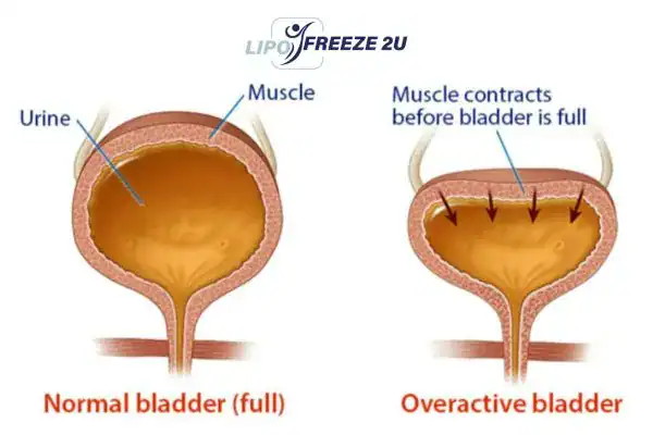 diagram of overactive bladder treatment Greenock