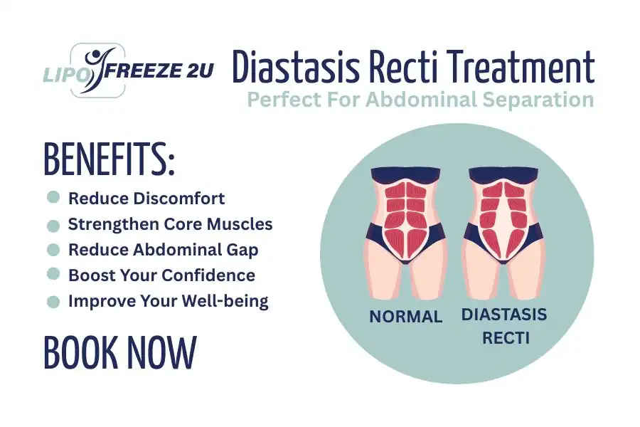 How Long Will It Take to See Improvements in Diastasis Recti Greenock