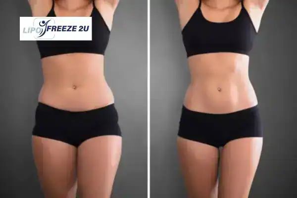 How Can LIPO FREEZE 2U Support Your Post-Pregnancy Body Recovery Greenock?