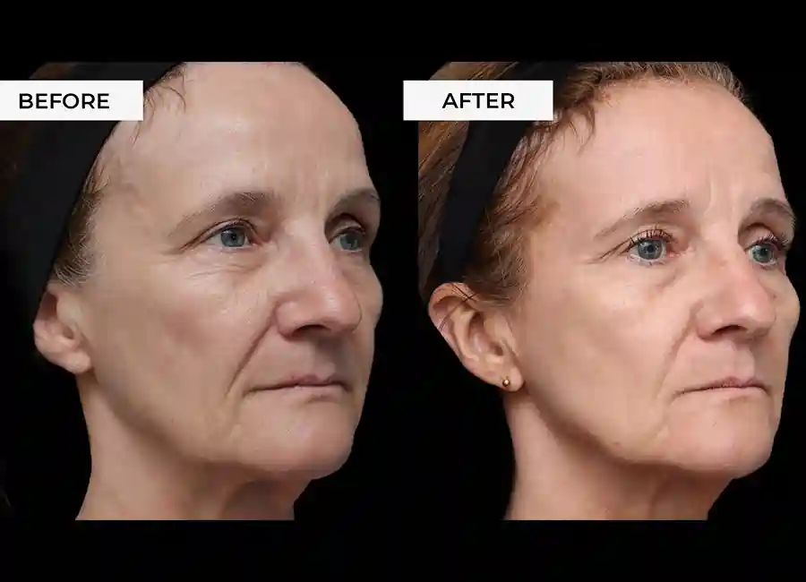 How Many RF Microneedling Sessions Will You Need to See a Difference Greenock?