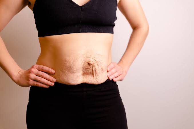 Is Surgery Really the Only Way to Repair Diastasis Recti Greenock?