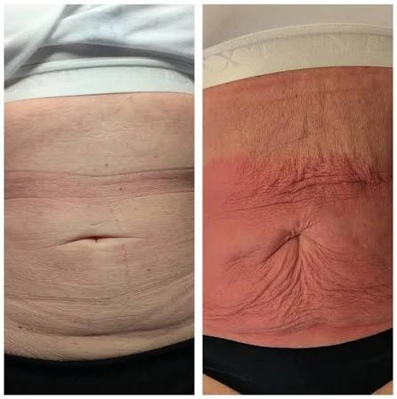 How Does RF Microneedling Improve Crepey, Thin and Uneven Skin Texture Greenock?