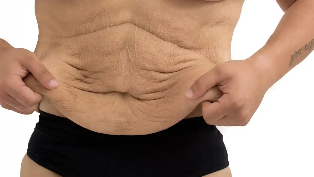 Why Does Weight Loss Medication Leave Some People With Loose or Sagging Skin Greenock?